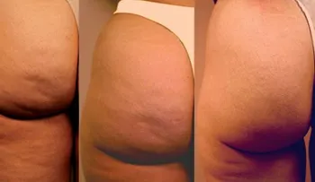 Lo nuevo para lucir una piel suave y libre contra la celulitis