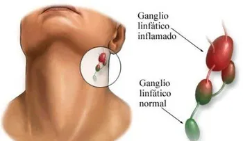¿Qué causa la inflamación de los ganglios linfáticos?