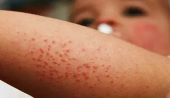 Declaran emergencia sanitaria en Washington por brote de sarampión 