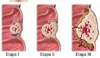 Lo que debes saber sobre el cáncer de colon