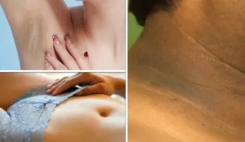 Mis rodillas, cuello y axilas estaban negras, con esto las blanqueé en 5 días
