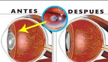 Restaura la visión de tus ojos casi por completo con azafrán