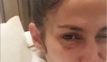 Jennifer López sube foto a Instagram con el ojo "morao"