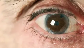 Glaucoma: descubre cuándo ocurre y cómo evitarlo