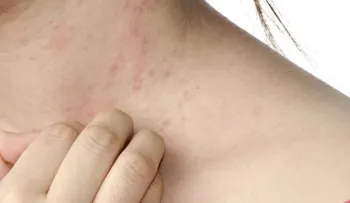 Consejos para tratar la dermatitis de contacto