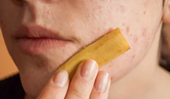 Métodos que FUNCIONAN para eliminar lunares, fibromas, espinillas, verrugas y manchas de la piel