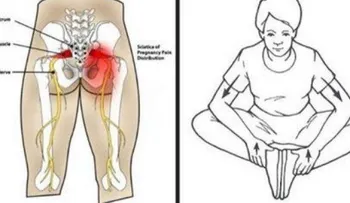 Como quitarse el dolor ciático de inmediato