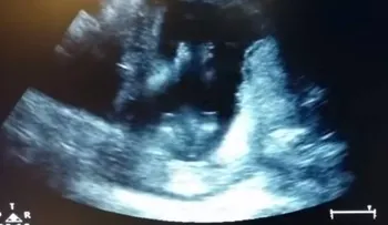 Feto de 14 semanas aplaude durante un sonograma