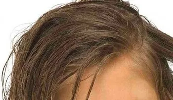 Remedios para los piojos: Mayonesa y vinagre, enjuague bucal y un champú natural