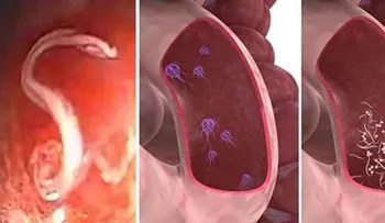 Si sientes estos síntomas significa que tienes los intestinos llenos de parásitos. Soluciones para eliminarlos