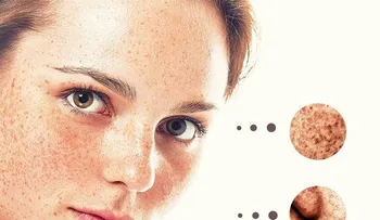 Si con esta receta no eliminas las manchas de tu piel y rostro ninguna otra cosa lo hará!