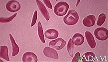 Anemia falciforme: tratamientos y terapias