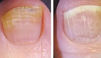 3 ingredientes para eliminar por completo hongos de las uñas 