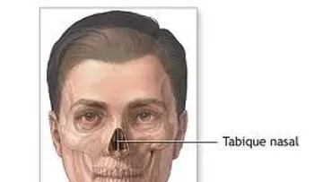 El tabique nasal podrá ser reconstruido totalmente, gracias a una nueva cirugía 