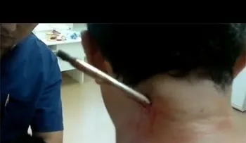 Espeluznante escena: Arpón disparado por error por su amigo le atraviesa el cuerpo