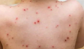 El Sistema Epidemiológico de México detecta cuatro nuevos casos de sarampión; emiten alerta 