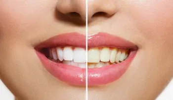 6 motivos por los que tus dientes lucen amarillos