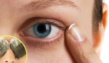 Cómo eliminar las ojeras bajo los ojos con remedios caseros