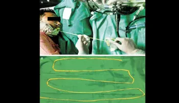 Doctores impactados: Una solitaria de 1,8 metros de largo salió por la boca de este hombre