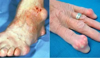 Revelan el secreto para la cura del reumatismo, artritis y articulaciones