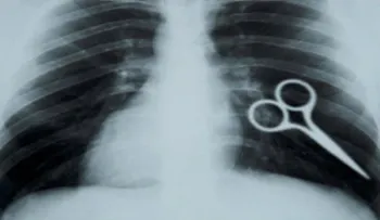 5 objetos horribles encontrados en el cuerpo humano