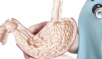 Seis síntomas del cáncer estomacal que no tienen nada que ver con el dolor