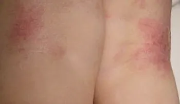 Las sábanas y fundas de almohadas producen bacterias, sudor y ácaros, que te irritan y pican la piel 