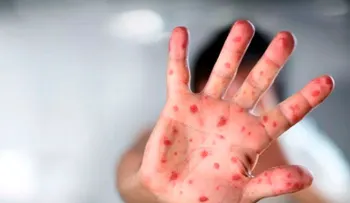 Unicef advierte de un aumento "alarmante" del sarampión a nivel mundial