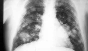 5 factores riesgo cáncer de pulmón