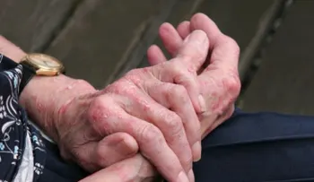 El Lupus Eritematoso Sistémico afecta distintos órganos del cuerpo
