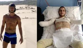 Error imperdonable: Amputan a un italiano los brazos y las piernas por un diagnóstico equivocado 