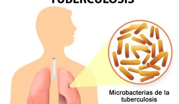 8 remedios muy eficaces para la tuberculosis