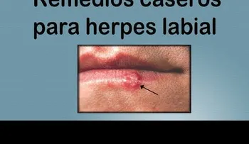 Como frenar un herpes labial con este sencillo truco (VIDEO)
