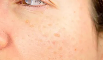 La exposición al sol es principal causa de hiperpigmentación
