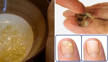 Se llama destroza hongos porque elimina todos los hongos de las uñas de una pasada