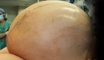 Extraen un tumor de ovario de 60 kilos de una mujer de Connecticut, EE.UU.