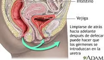 Causas y soluciones de las infecciones urinarias  