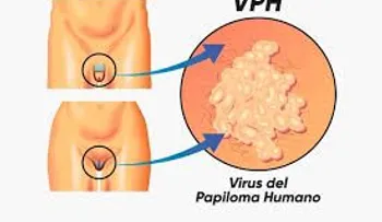 El virus del Papiloma humano y los beneficios de la vacuna; descubre todo sobre esta enfermedad