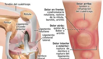 Riesgos de la artroplastia de cadera y de rodilla
