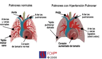 La hipertensión pulmonar, síntomas y causas