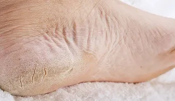 Cómo deshacerse de los pies secos con remedios naturales