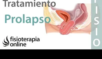 Qué es el prolapso en el suelo pélvico? - Tratamiento adecuado en fisioterapia