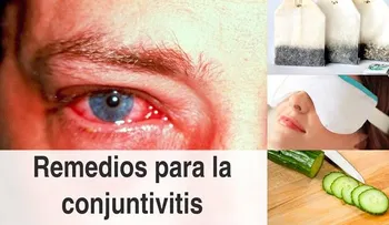 La conjuntivitis; remedios caseros 100 efectivos para curarte