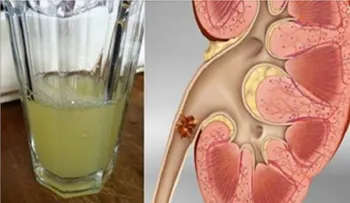 Observa como salen expulsadas todas las piedras del riñón con solo beber este remedio natural