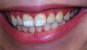 Qué son las manchas blancas en los dientes