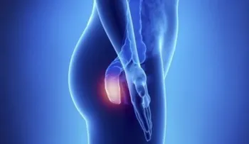 5 síntomas del cáncer de ano, una enfermedad silenciosa 