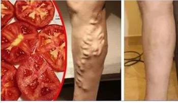 El remedio de un doctor para acabar con las varices en las piernas: tomates verdes y tomates rojos maduros