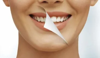 ¿Cómo blanquear los dientes en una hora?