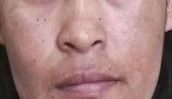Cómo eliminar las manchas de la cara