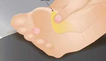 Como aliviar tu dolor de cabeza con reflexología en los pies
